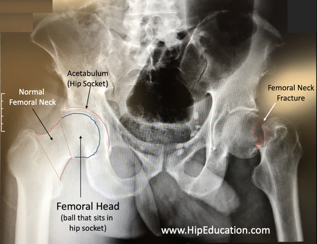 Femoral Neck Fracture Hipeducation