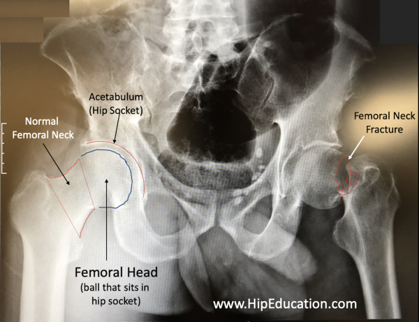 femoral-neck-fracture-hipeducation