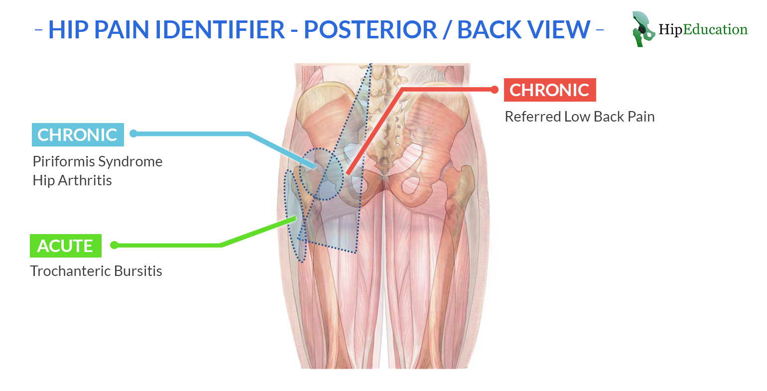 Hip Pain Identifier Posterior View HipEducation