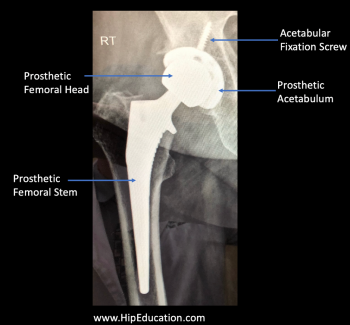 hemiarthroplasty femoral neck fracture