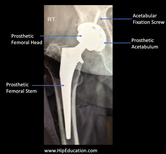 Total Hip Replacement HipEducation